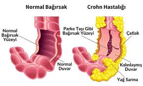 Crohn Hastalığı Nedir ve Tedavi Yöntemleri